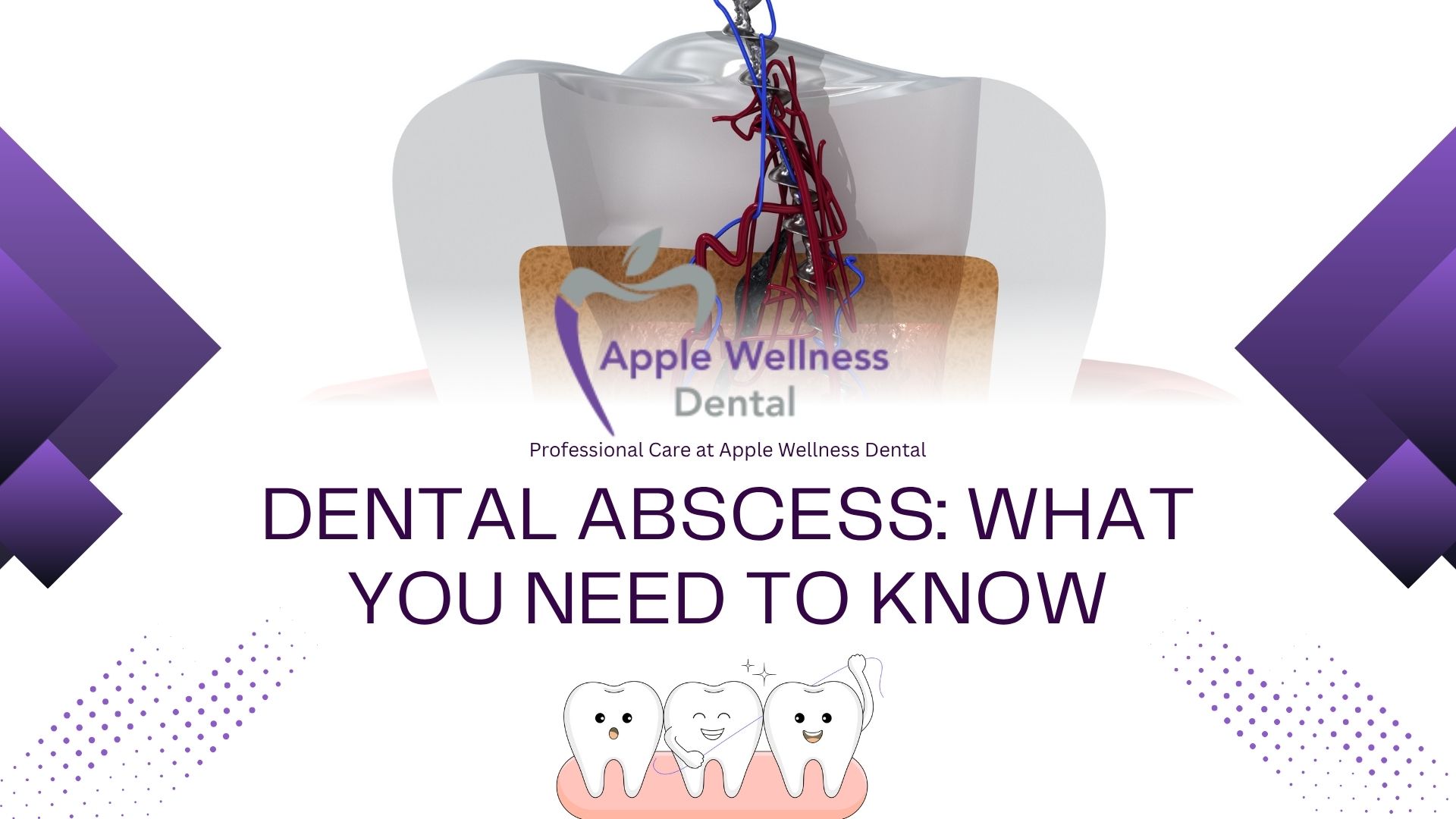Dental Abscess: What You Need to Know | Apple Wellness Dental - Apple Wellness Dental
