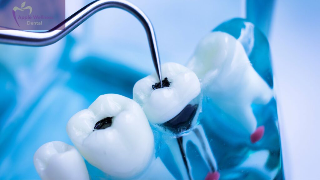 How to Treat a Tooth Infection at Apple Wellness Dental in Airdrie - Apple Wellness Dental