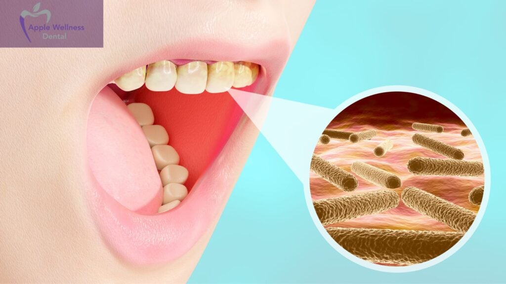 How to Treat a Tooth Infection at Apple Wellness Dental in Airdrie - Apple Wellness Dental