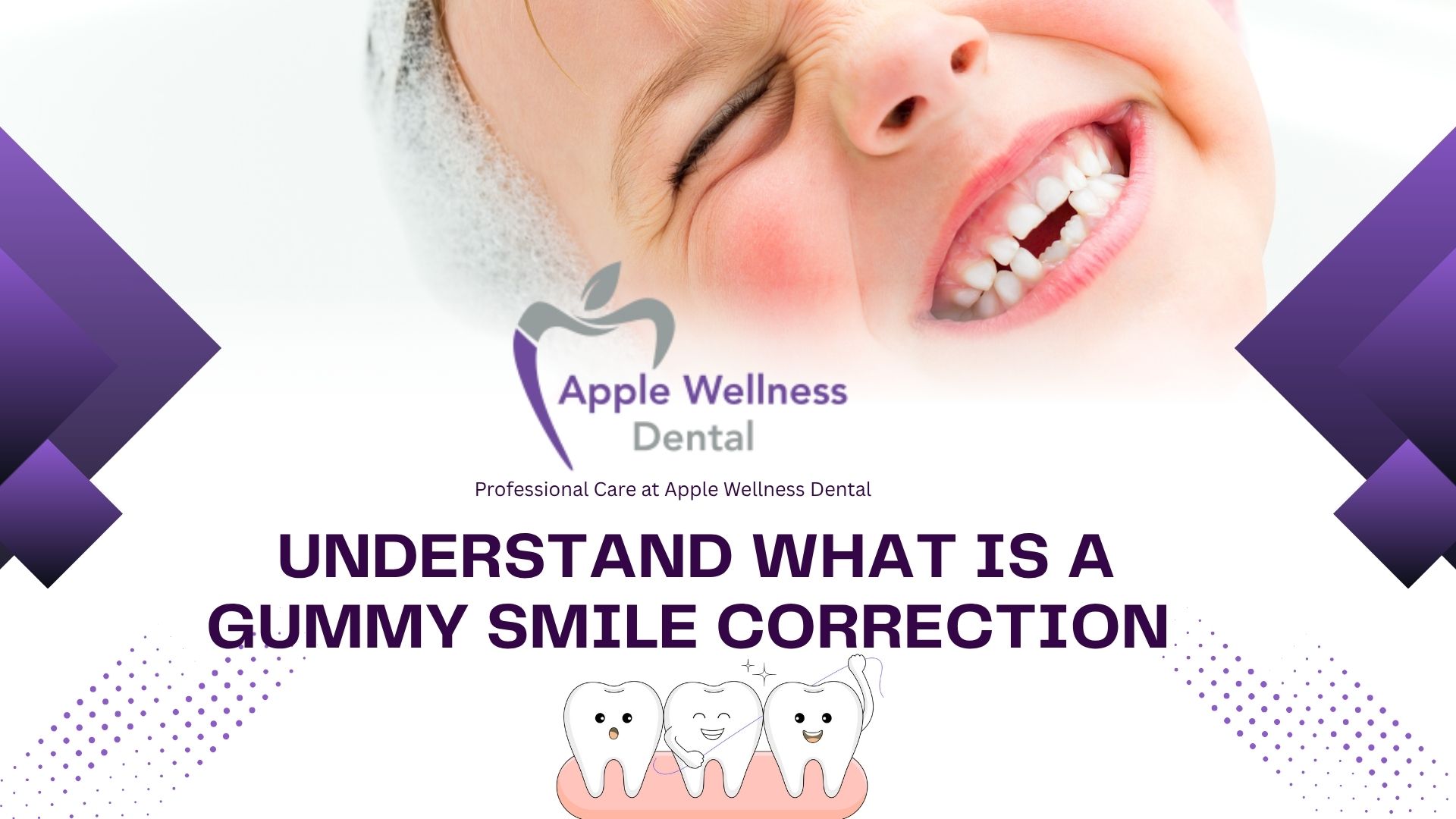 Understand What is a Gummy Smile Correction with Apple Wellness Dental - Apple Wellness Dental