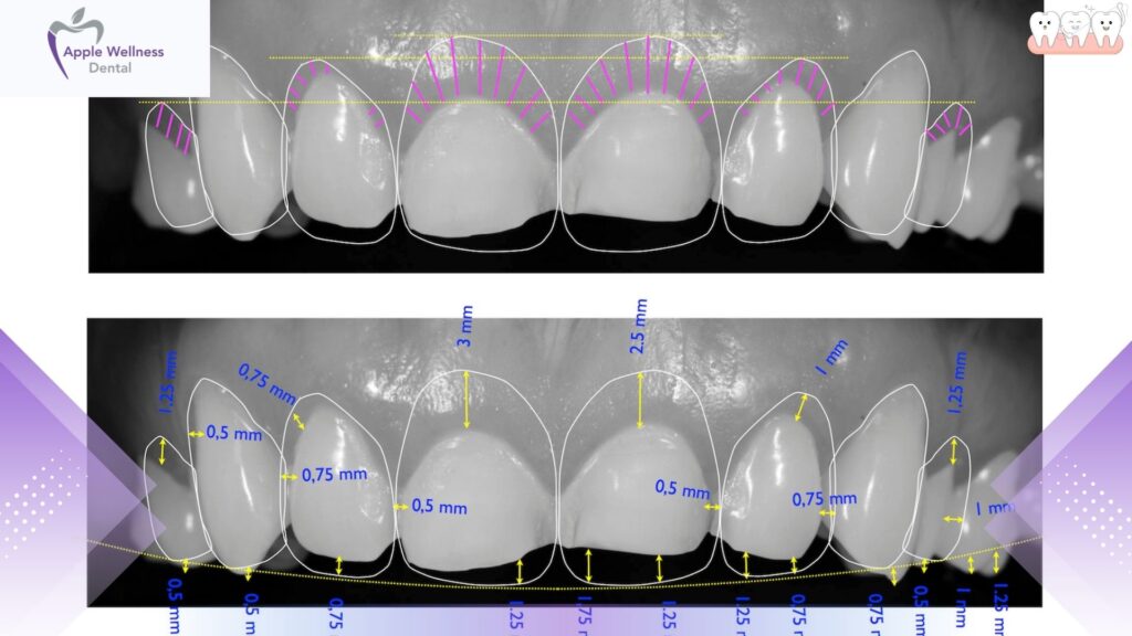 Discover What is a Digital Smile Design at Apple Wellness Dental - Apple Wellness Dental