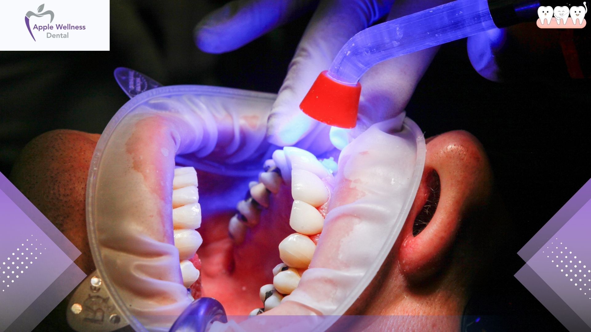 What Are Dentist Fillings and How Do They Work? Everything You Should Know - Apple Wellness Dental