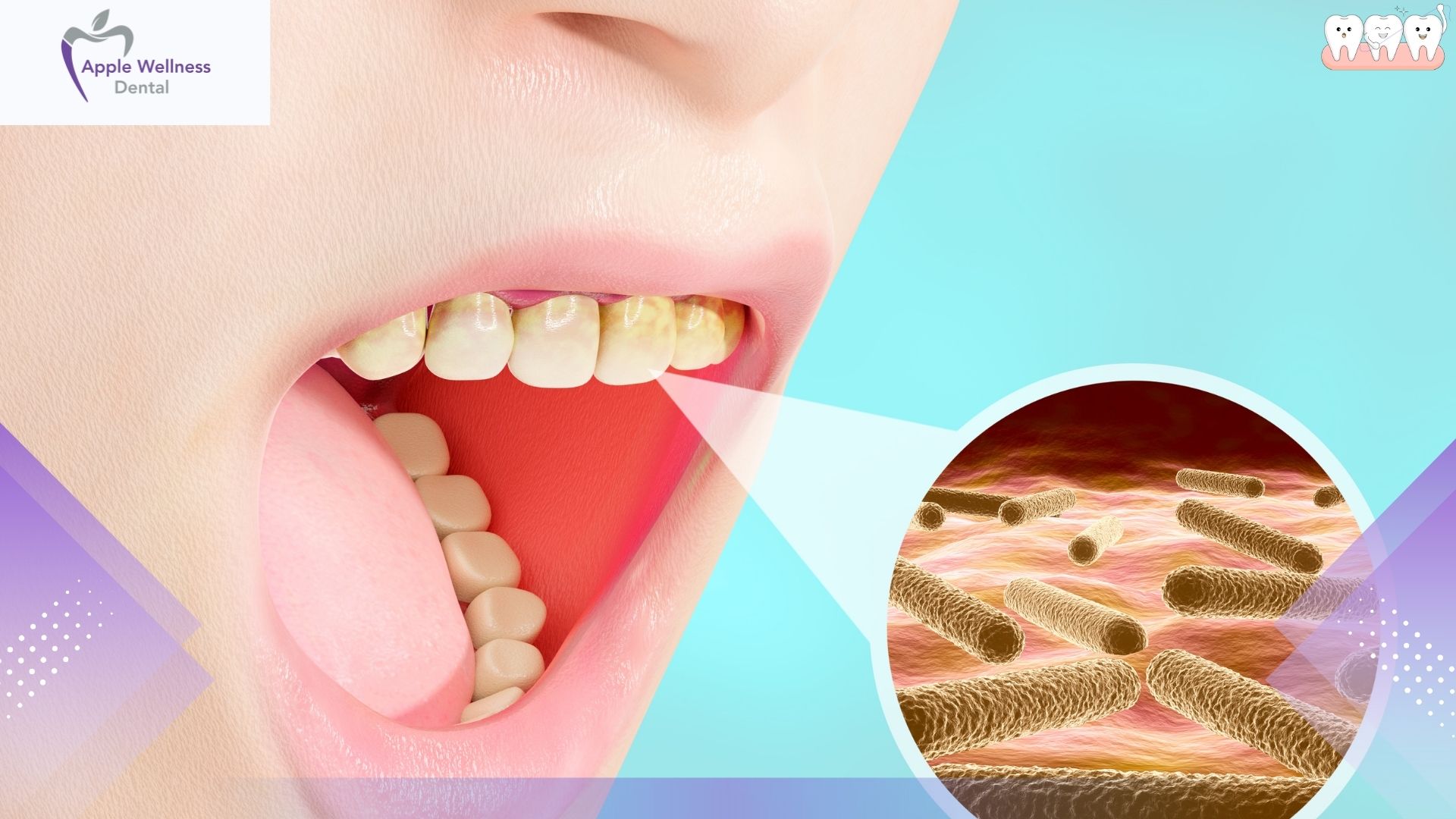 Why No Dairy After Tooth Extraction Is Important for Healing - Apple Wellness Dental