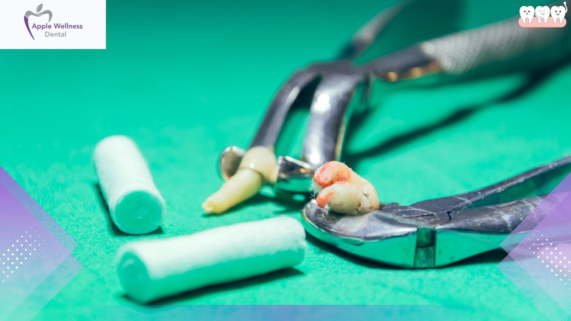 How Long Will It Bleed After Wisdom Tooth Extraction? - Apple Wellness Dental