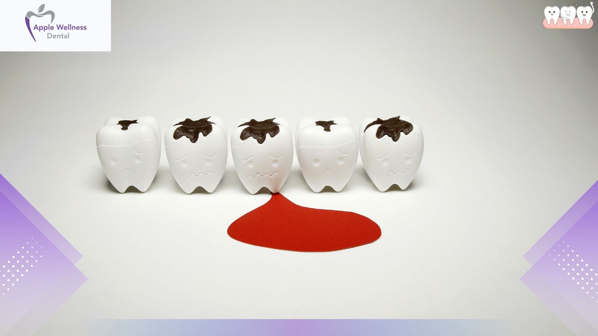 How Long Will It Bleed After Wisdom Tooth Extraction? - Apple Wellness Dental