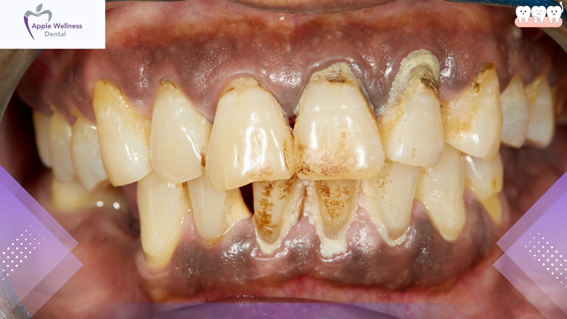 Can You Reverse Periodontitis? Expert Care Guide - Apple Wellness Dental