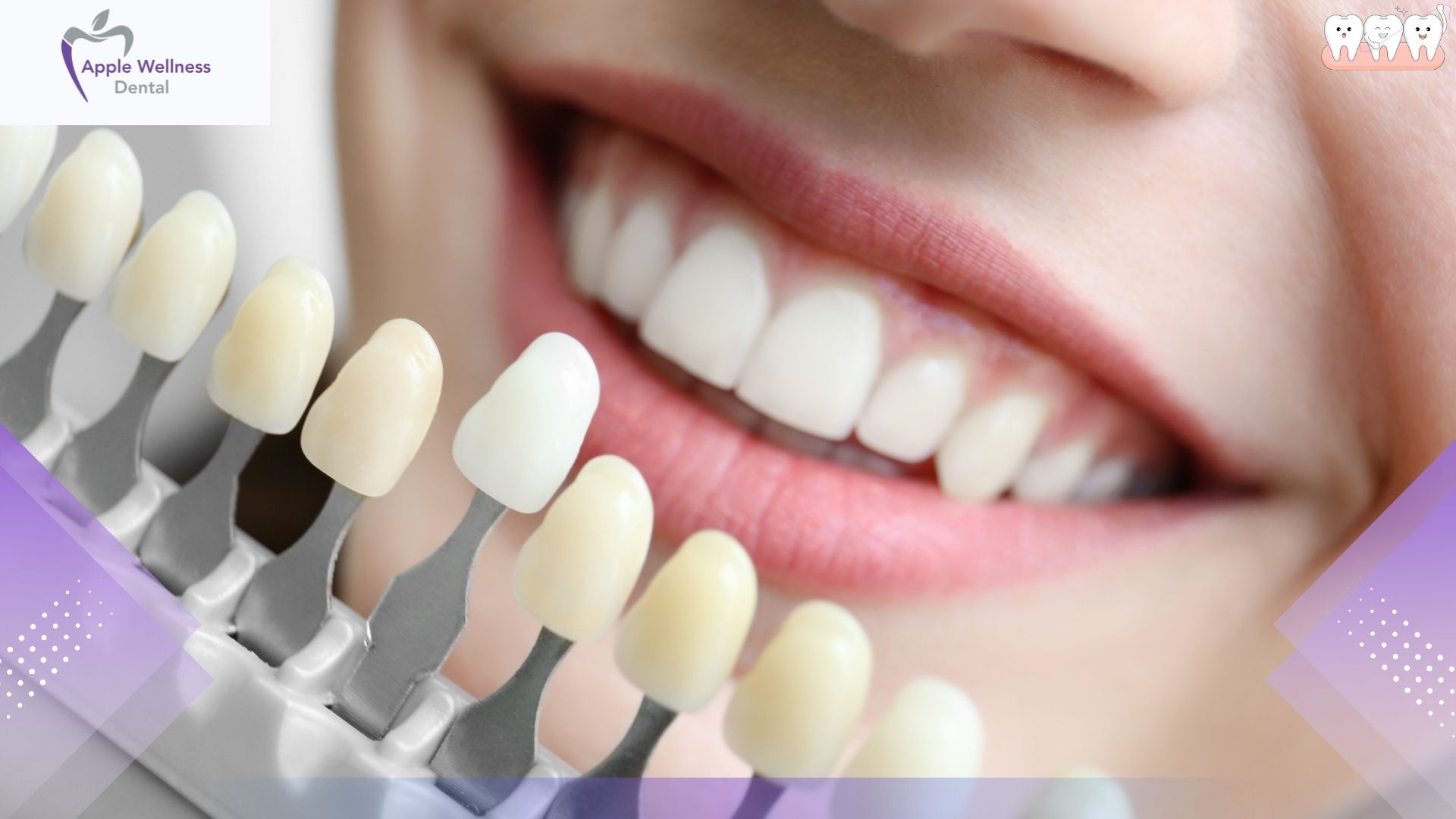 How Long Do Cosmetic Dentistry Results Last in Airdrie? - Apple Wellness Dental