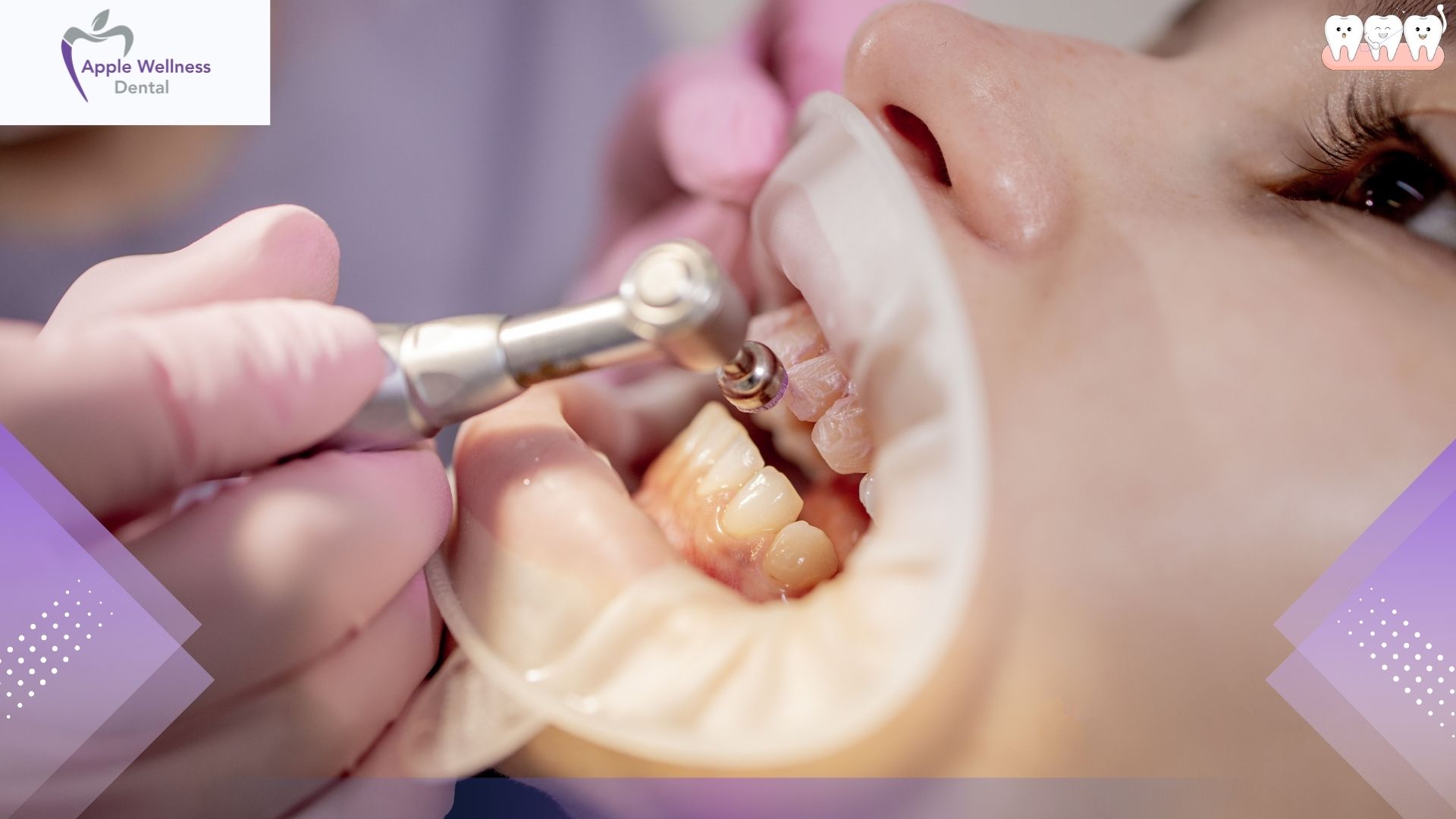 Can You Whiten Veneers Without Damaging Them - Apple Wellness Dental
