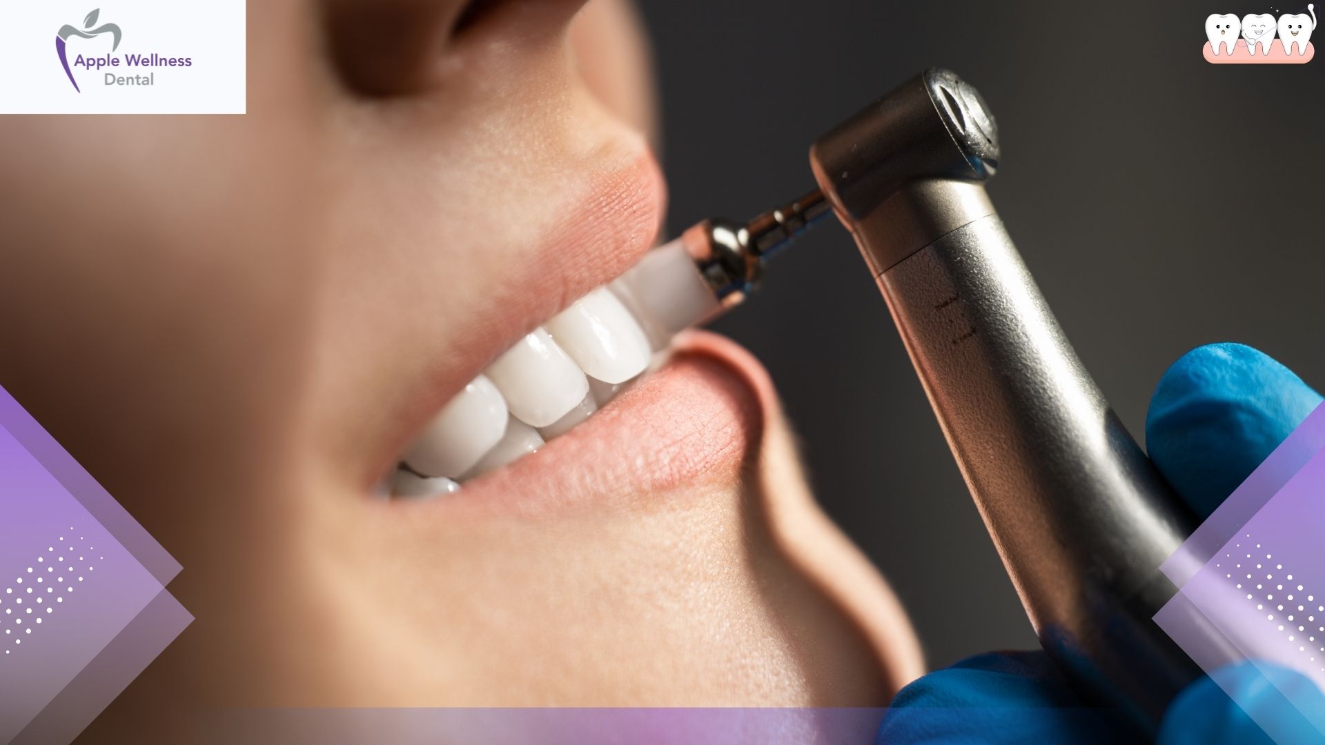 What Happens During a Hygiene Therapy Appointment Explained - Apple Wellness Dental