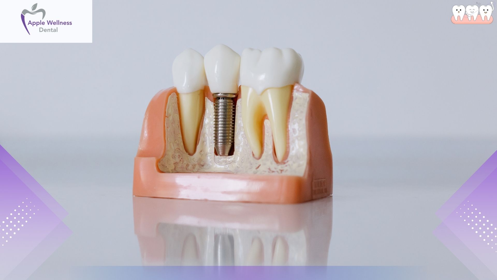 How Are Bridges Built to Restore Missing Teeth - Apple Wellness Dental