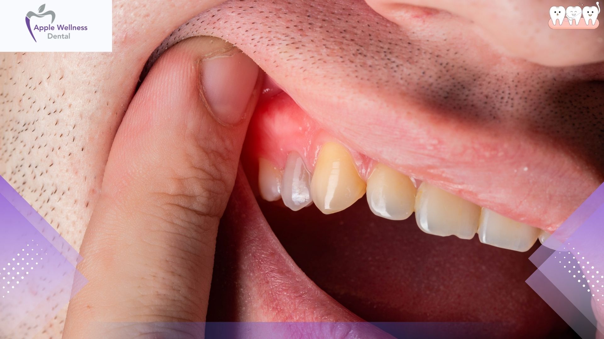 Can Gingivitis Kill You and What You Should Know About It - Apple Wellness Dental