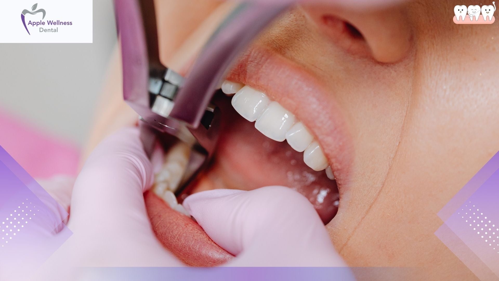 How Long Will It Bleed After Wisdom Tooth Extraction? - Apple Wellness Dental
