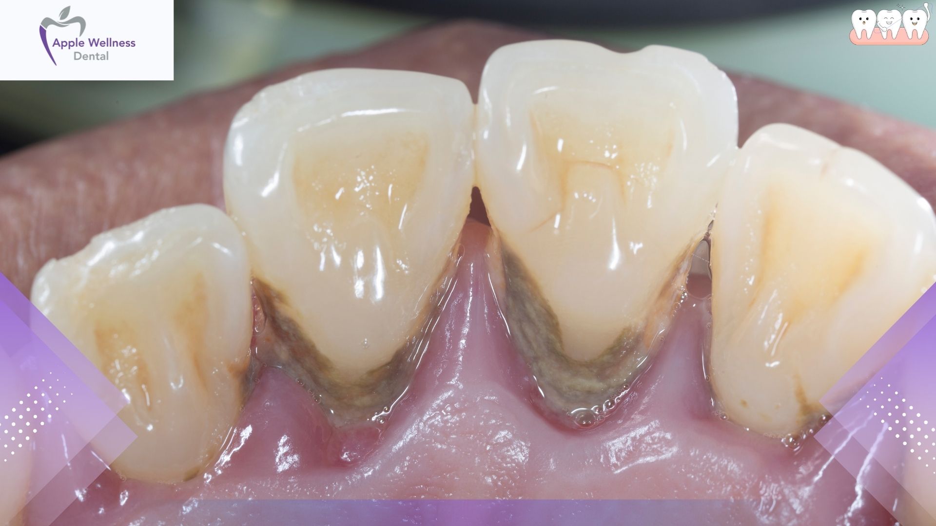 Can You Reverse Periodontitis? Expert Care Guide - Apple Wellness Dental