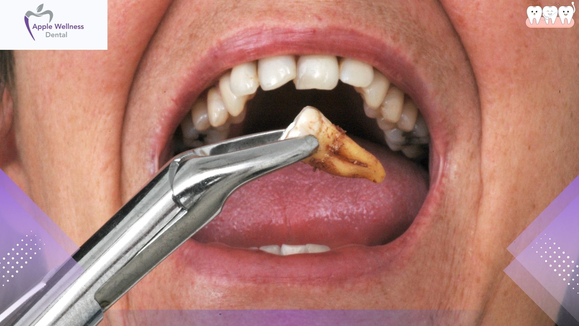 Can I Have Iced Coffee After Tooth Extraction Recovery - Apple Wellness Dental