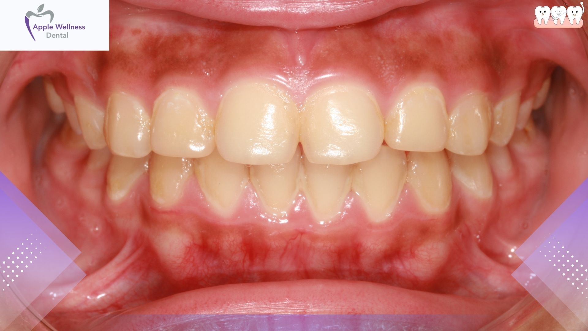 Does Gingivitis Go Away on Its Own or Require Treatment - Apple Wellness Dental