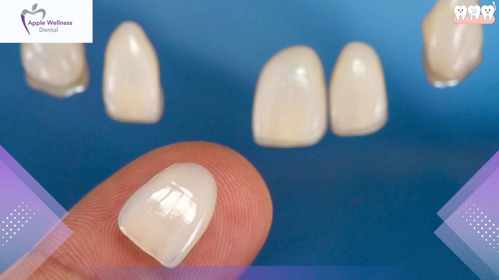 Can You Whiten Veneers Without Damaging Them - Apple Wellness Dental