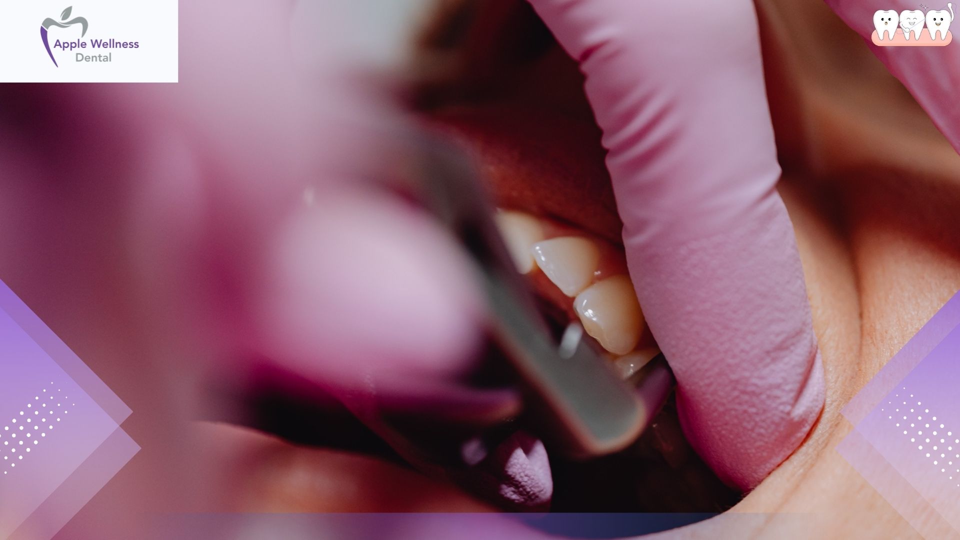 How Does Hygiene Therapy Prevent Gum Disease in Airdrie - Apple Wellness Dental