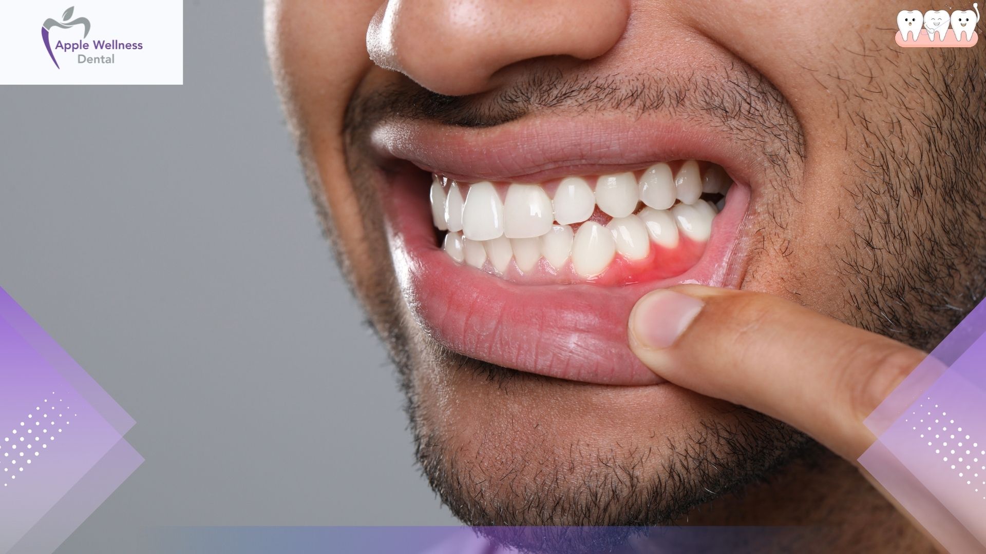 How Does Hygiene Therapy Prevent Gum Disease in Airdrie - Apple Wellness Dental