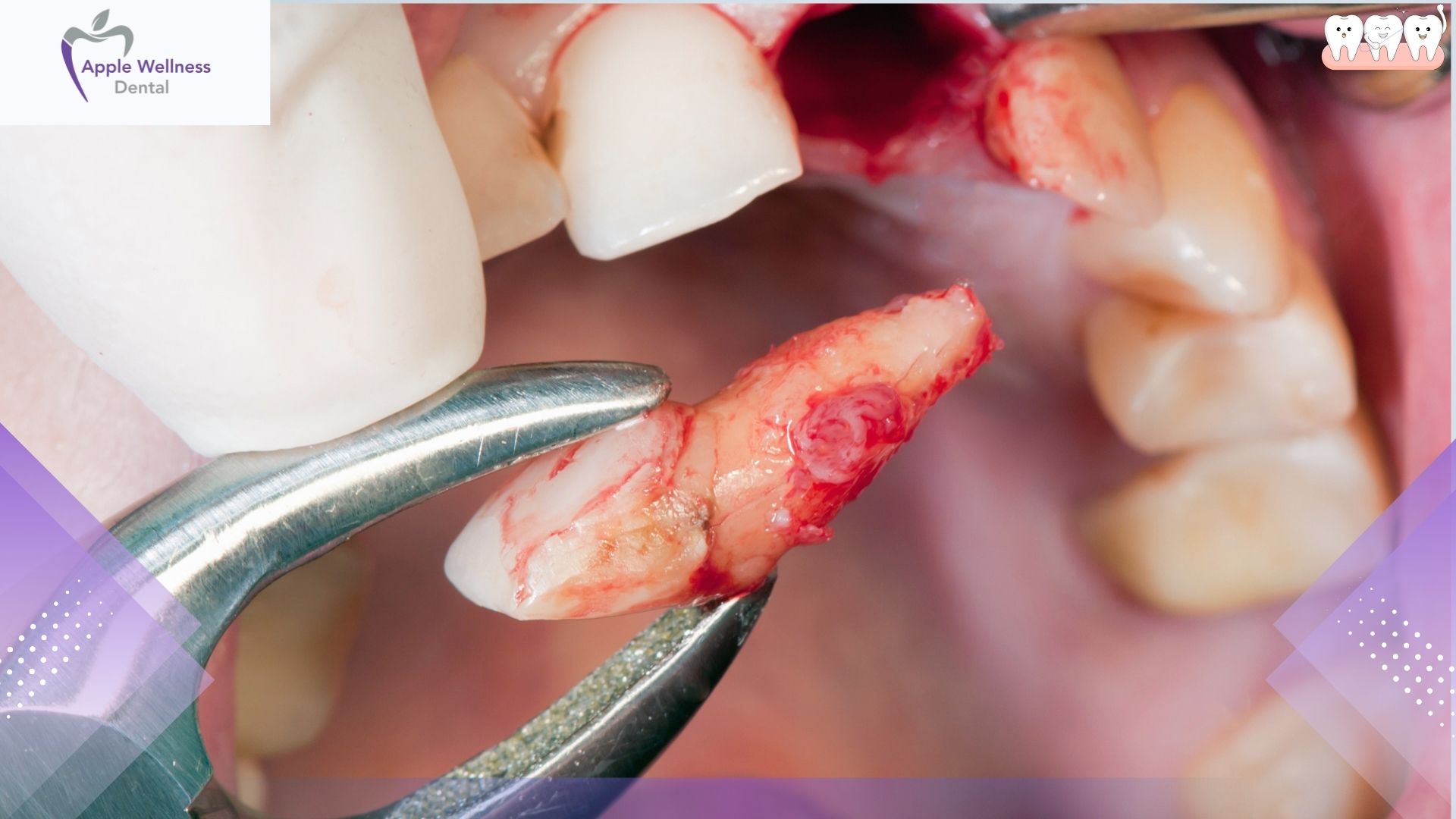 When Is a Dental Extraction Necessary in Airdrie Care - Apple Wellness Dental