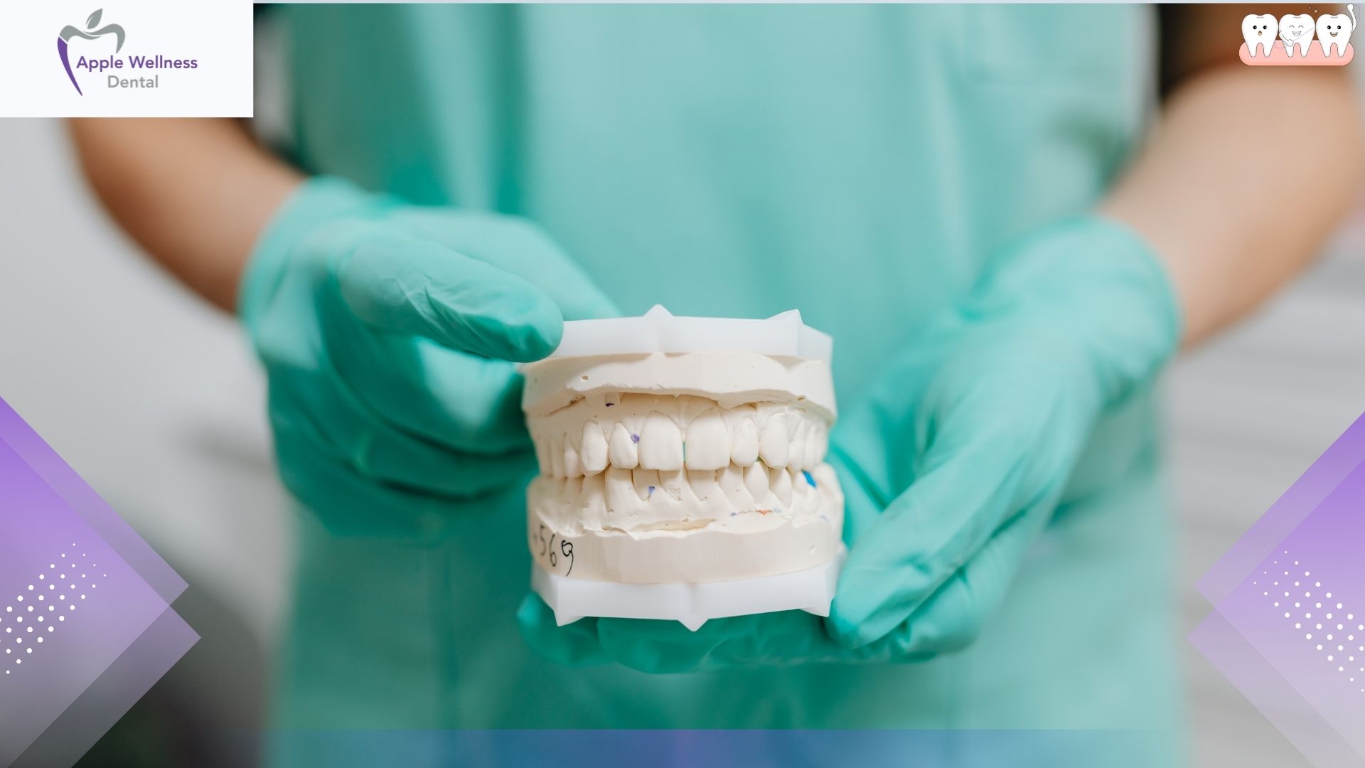 How Long Do Dental Implants Last - Apple Wellness Dental