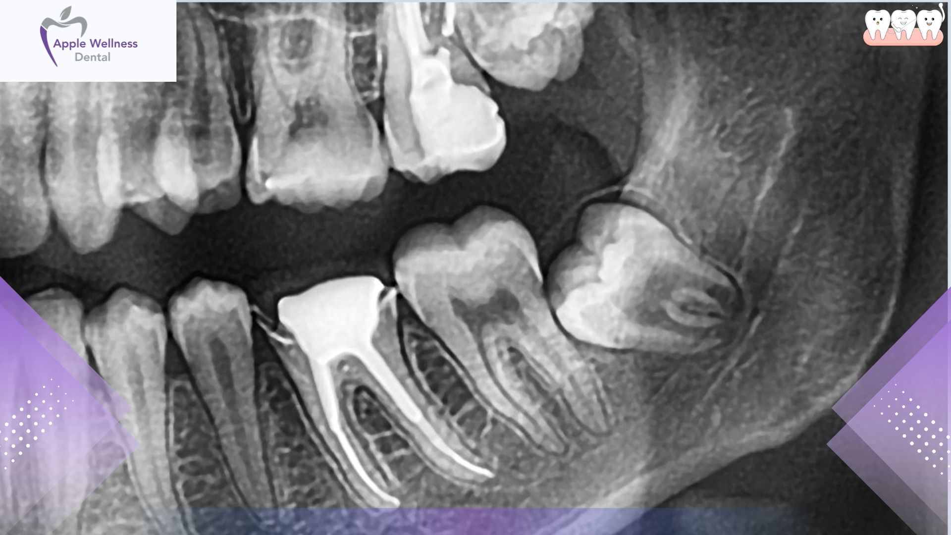 How Do Dentists Treat Knocked Out Teeth in Airdrie Today - Apple Wellness Dental