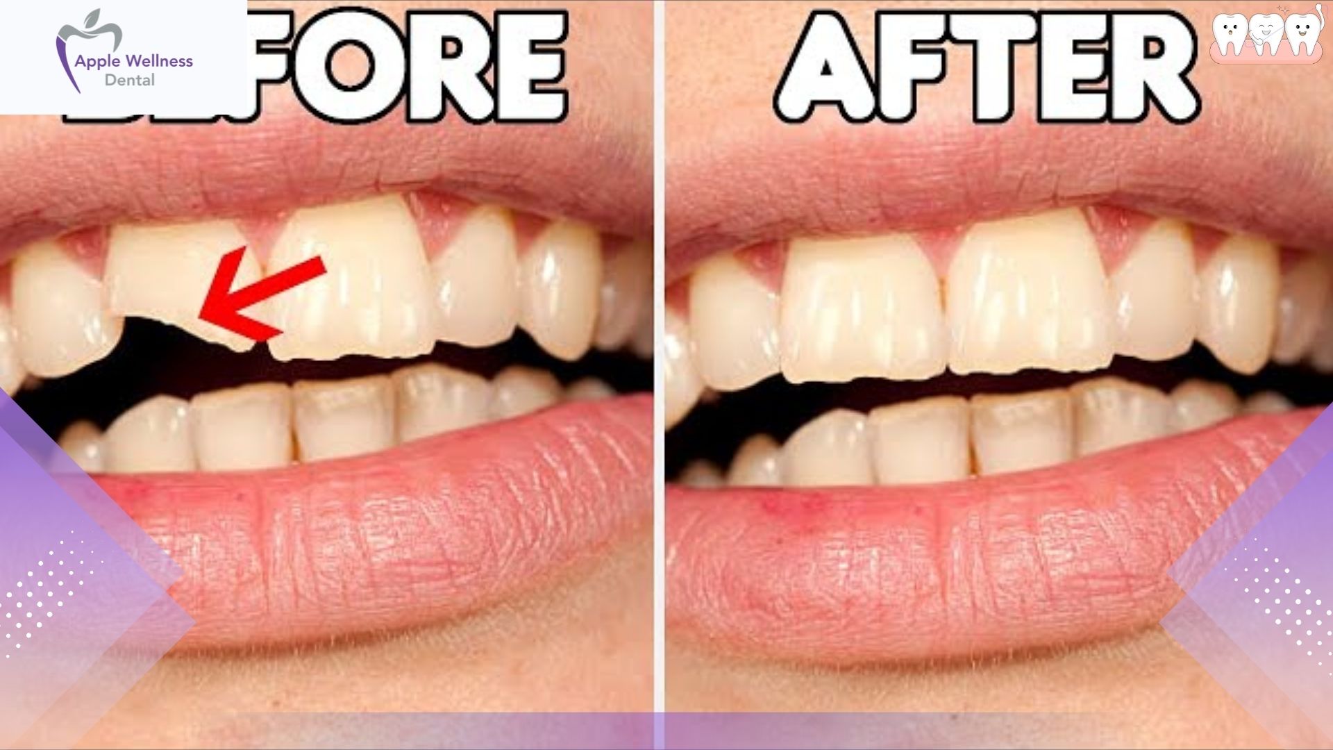 When Should You Visit a Dentist for a Chipped Tooth in Airdrie - Apple Wellness Dental