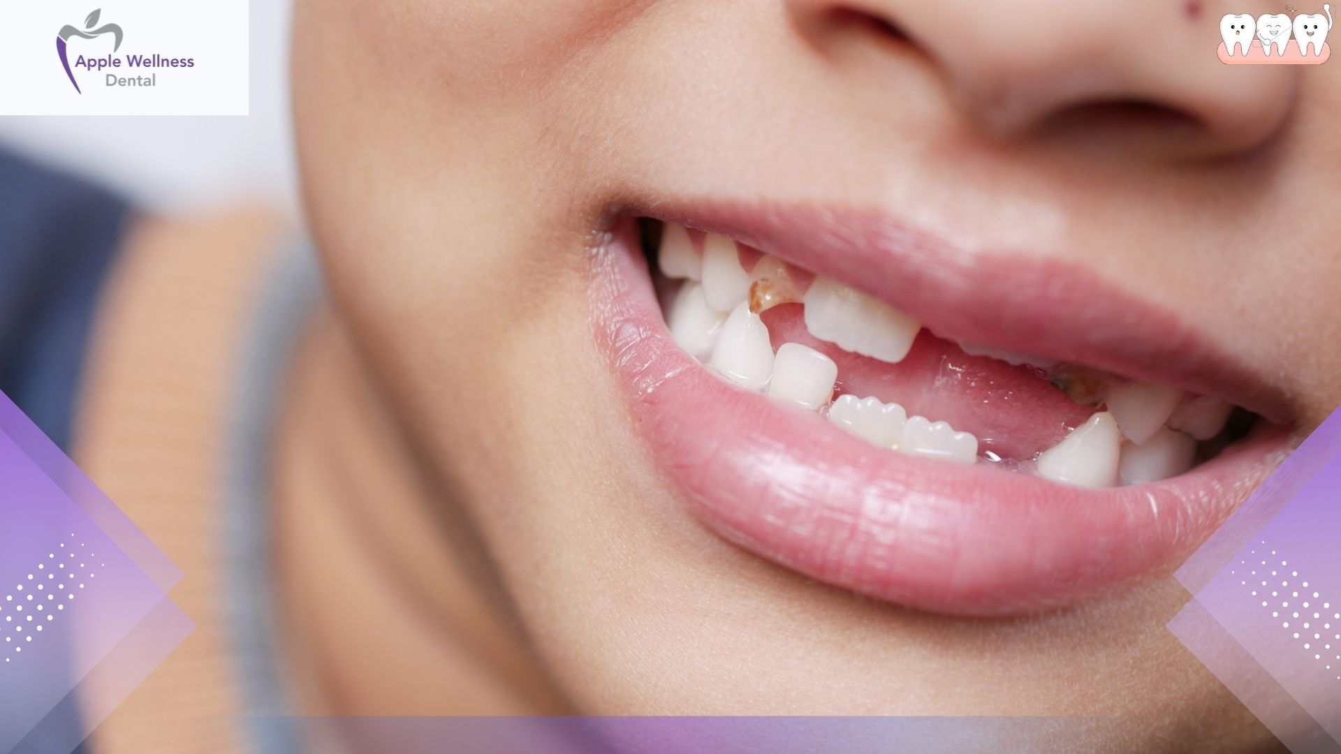 When Should You Visit a Dentist for a Chipped Tooth - Apple Wellness Dental