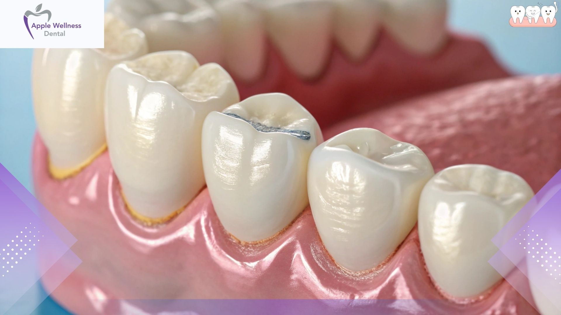 What Should You Do If You Lose a Filling - Apple Wellness Dental What Should You Do If You Lose a Filling - Apple Wellness Dental
