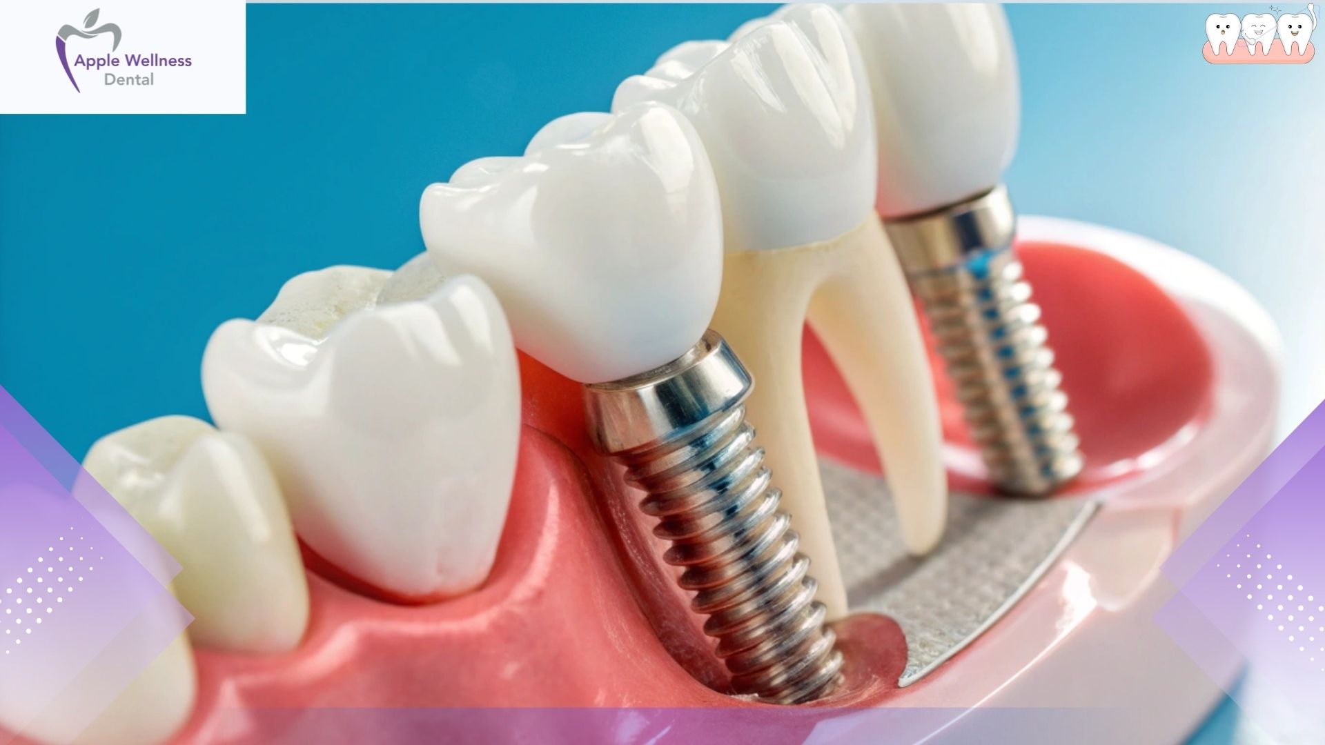 How Long Do Dental Implants Last - Apple Wellness Dental