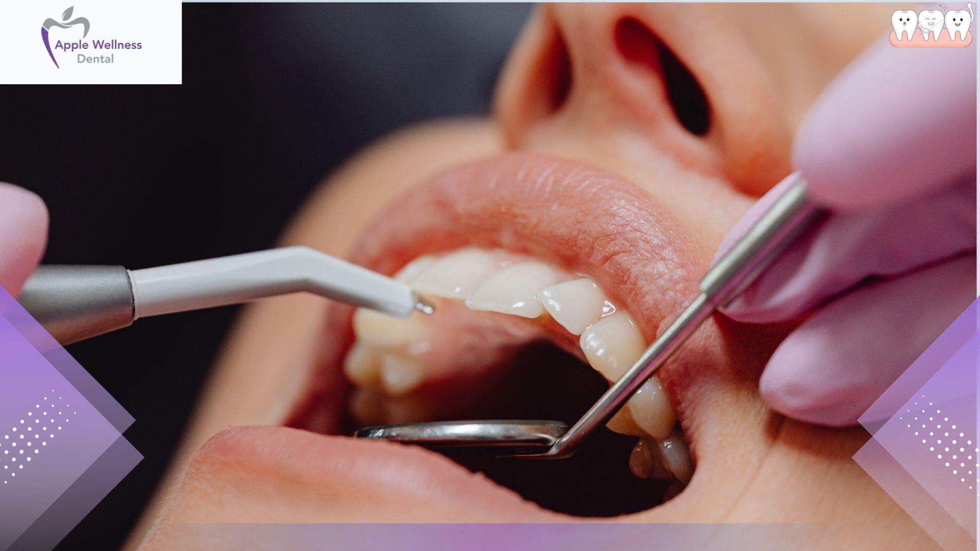 What Are the Risks of a Dental Extraction in Airdrie: A Complete Safety Guide - Apple Wellness Dental