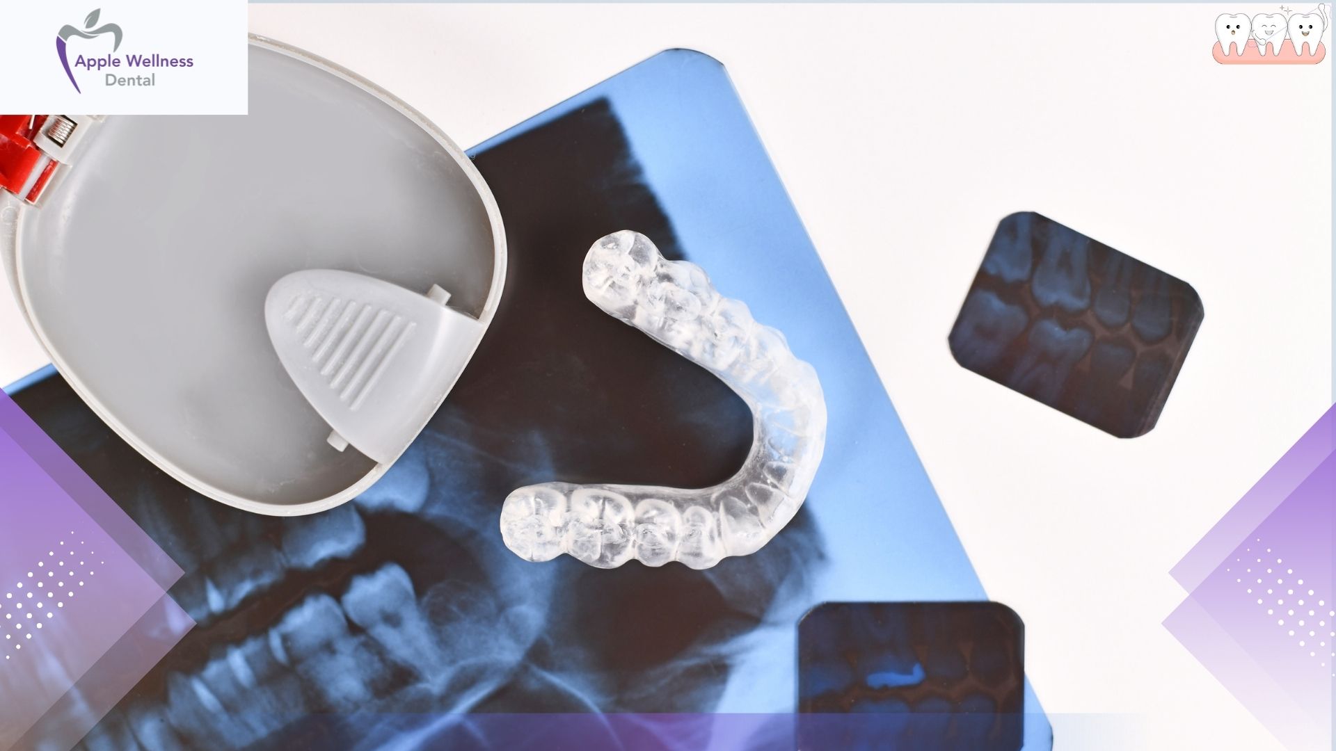 How Are Custom Mouthguards Made for Your Unique Smile - Apple Wellness Dental