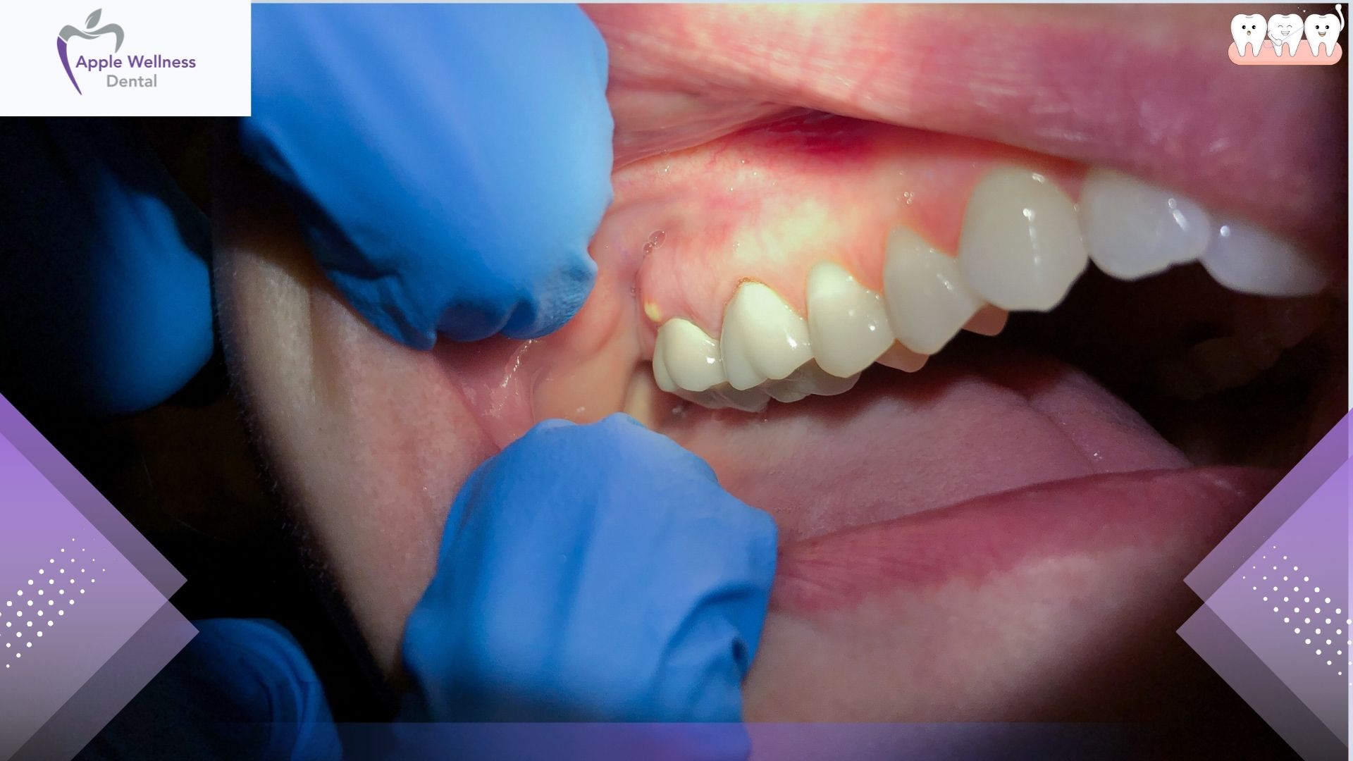 What Qualifies as a Dental Emergency in Airdrie - Apple Wellness Dental
