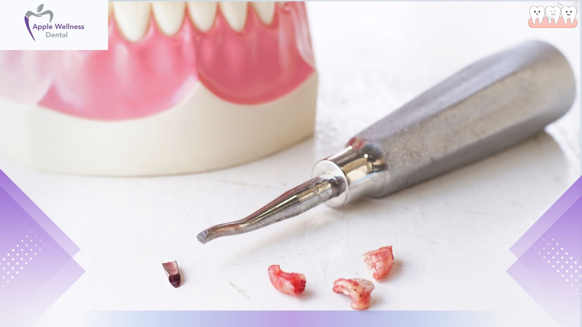 How Do Dentists Treat Knocked Out Teeth in Airdrie Today - Apple Wellness Dental