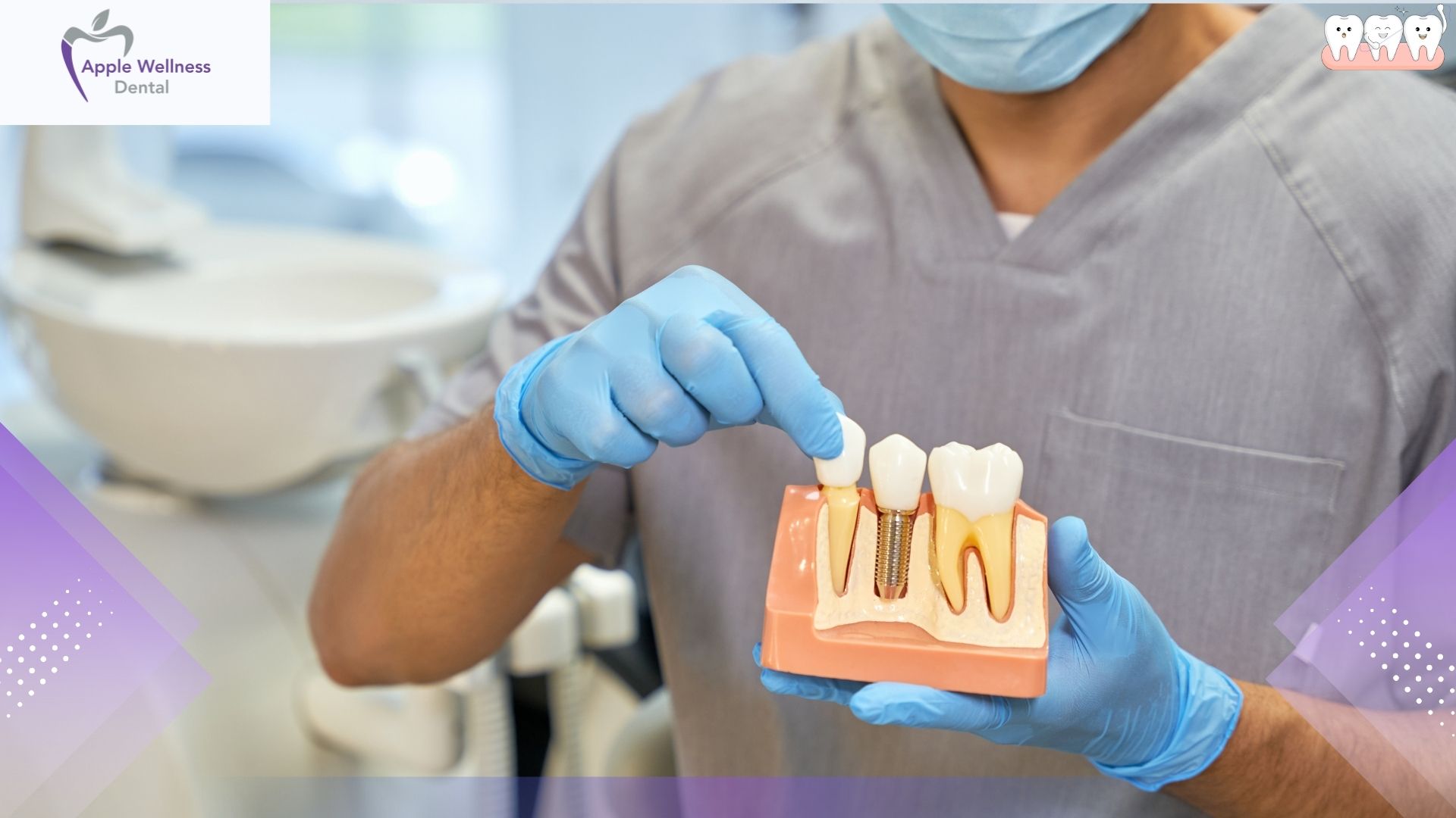 The Science of Stability: How Dental Implants Work in Your Jaw - Apple Wellness Dental