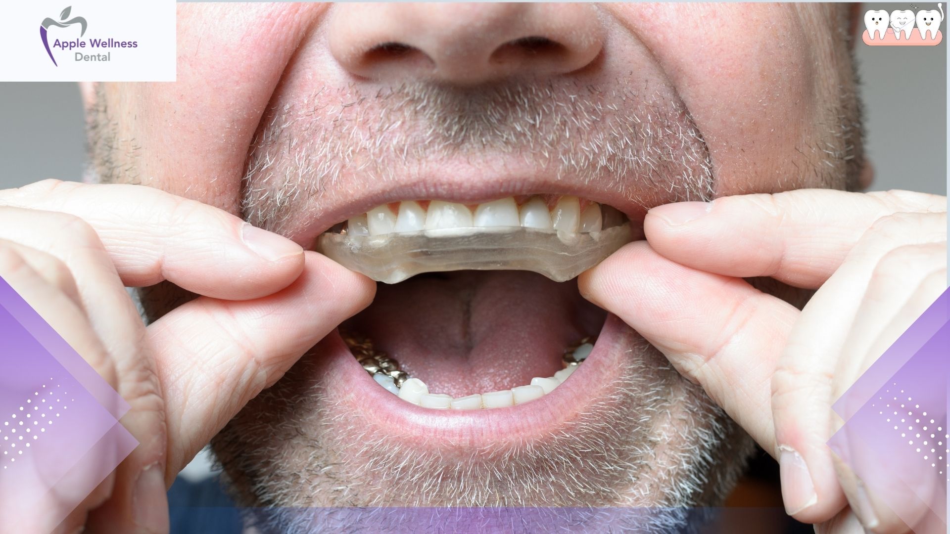 Why Are Custom Mouthguards Better Than Store Bought Options - Apple Wellness Dental