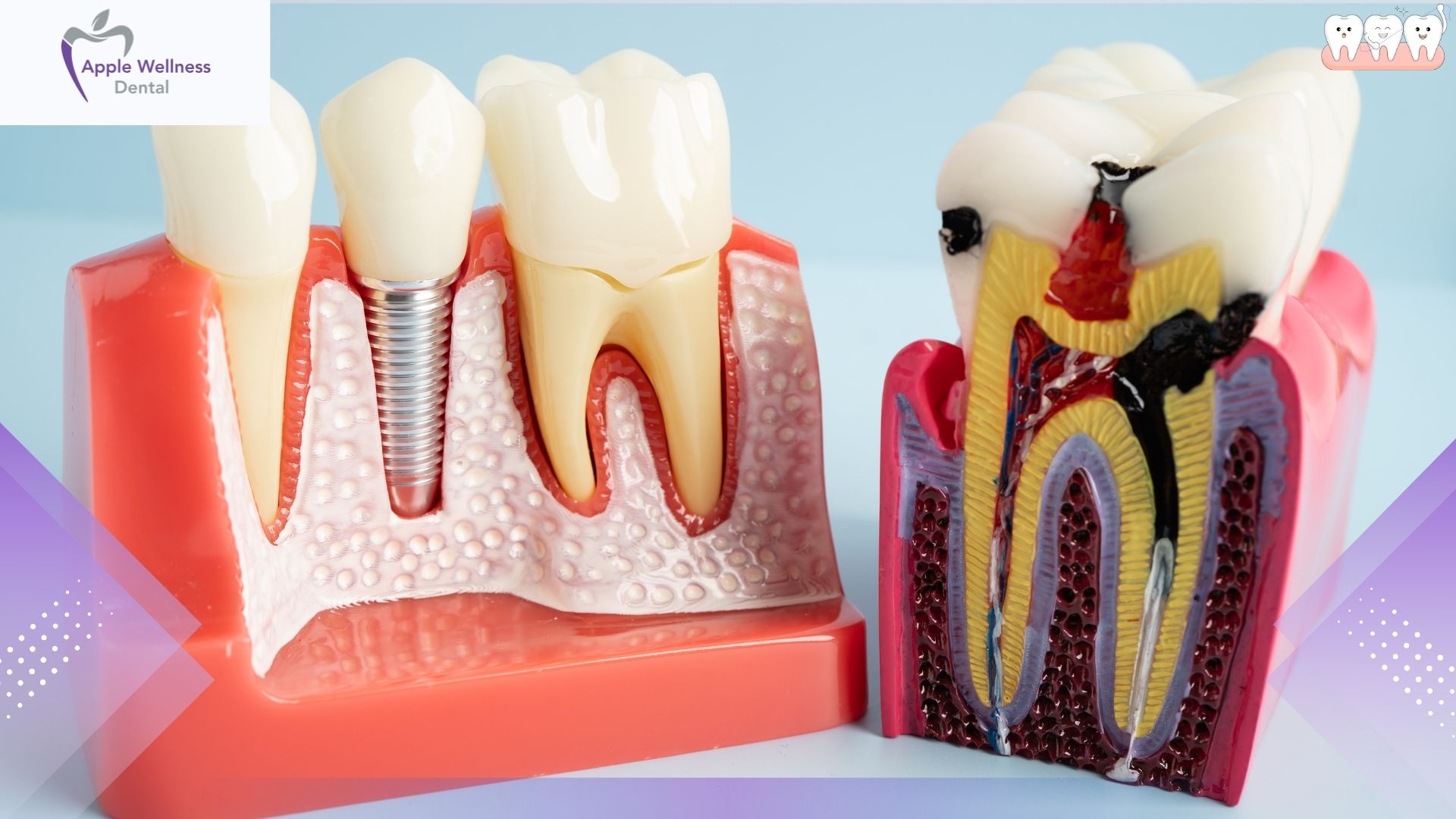 The Science of Stability: How Dental Implants Work in Your Jaw - Apple Wellness Dental