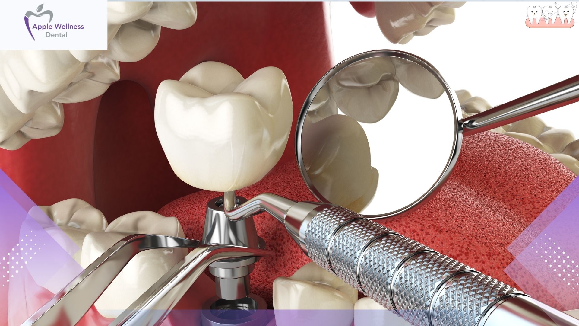 Airdrie Dental Implant Guide: How We Restore Your Smile from the Roots Up - Apple Wellness Dental