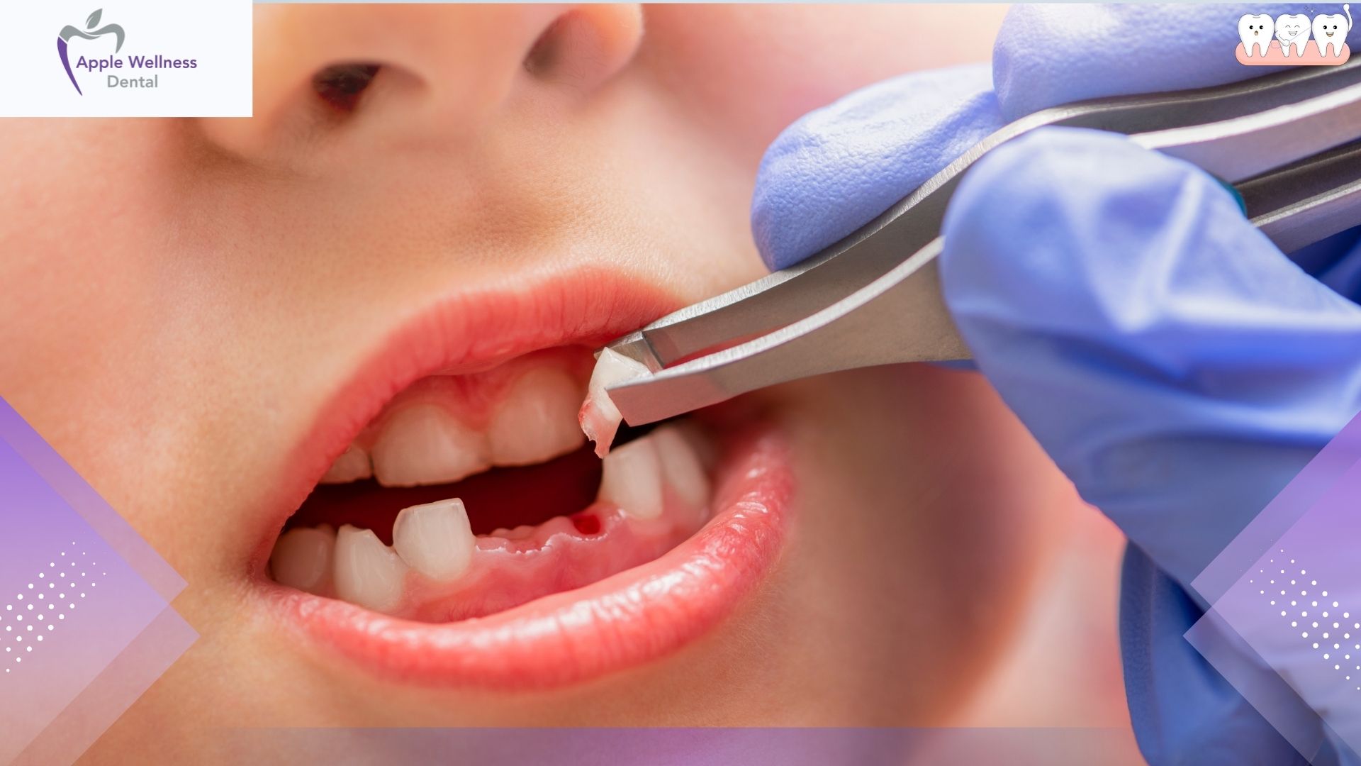 What to Expect During a Dental Extraction in Airdrie: A Complete Guide - Apple Wellness Dental