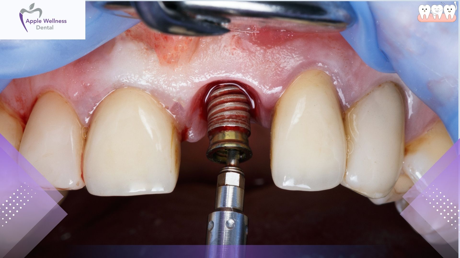 What Are the Risks of a Dental Extraction in Airdrie: A Complete Safety Guide - Apple Wellness Dental