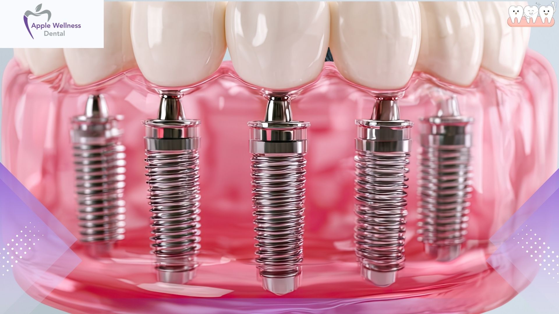How Long Do Dental Implants Last - Apple Wellness Dental