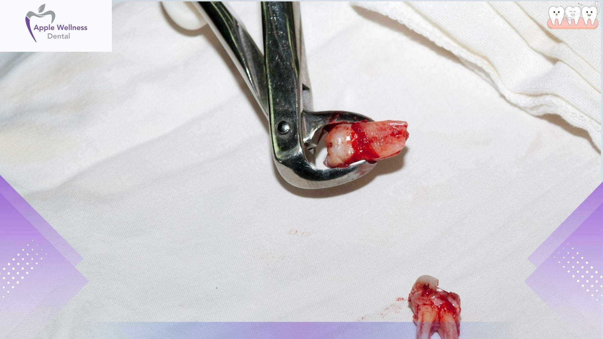What Is a Dental Extraction and Why Might You Need One - Apple Wellness Dental