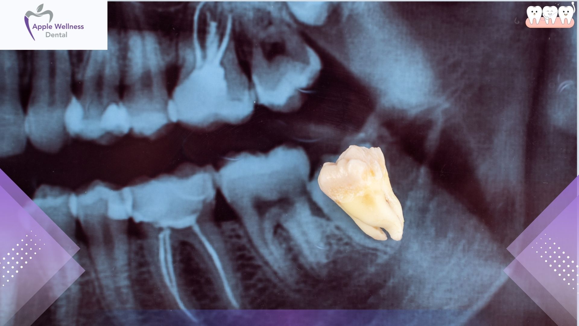 When Is a Dental Extraction Necessary in Airdrie Care - Apple Wellness Dental
