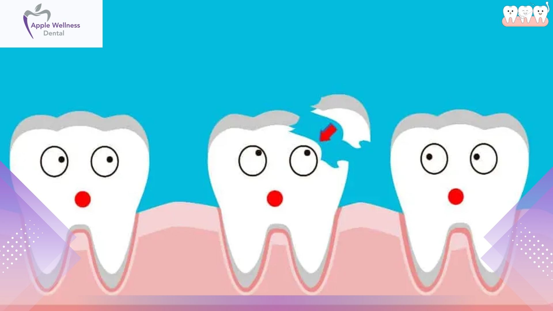 When Should You Visit a Dentist for a Chipped Tooth in Airdrie - Apple Wellness Dental