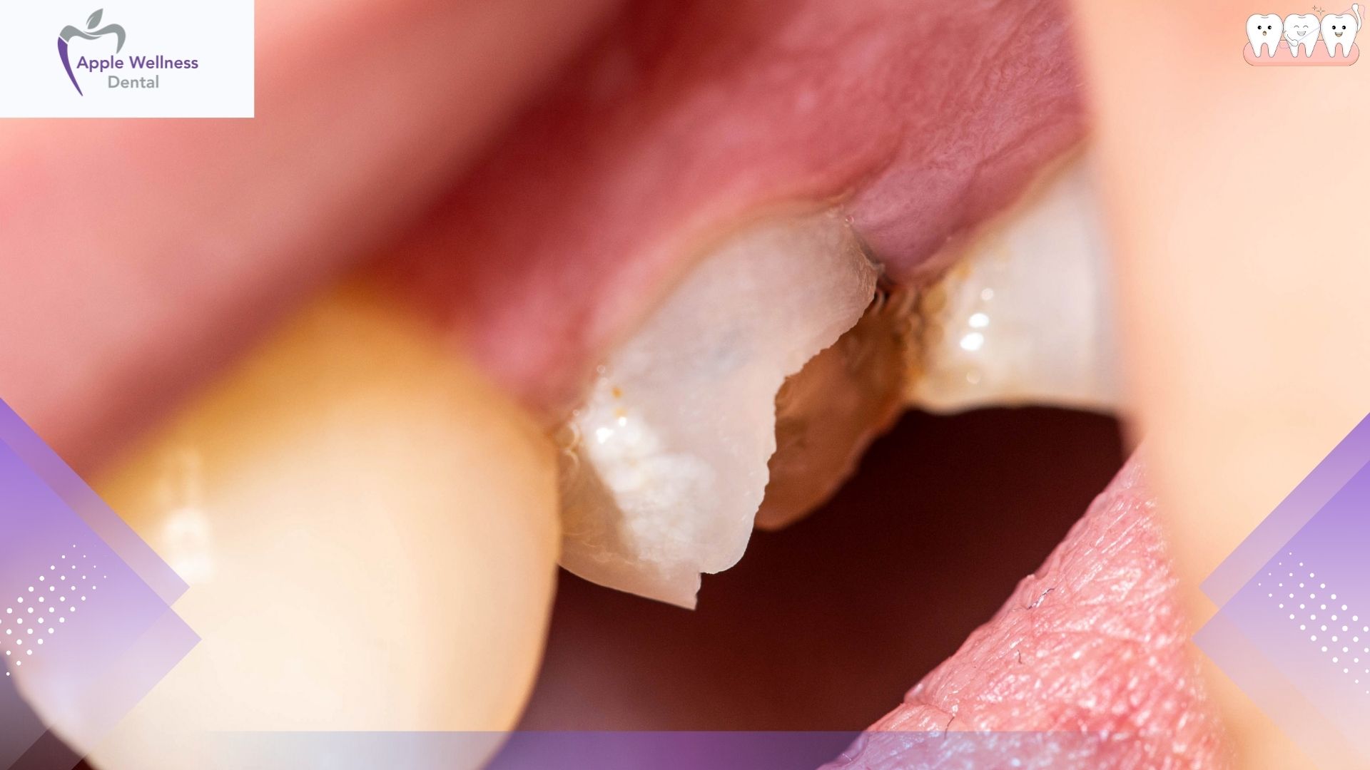 When Should You Visit a Dentist for a Chipped Tooth - Apple Wellness Dental