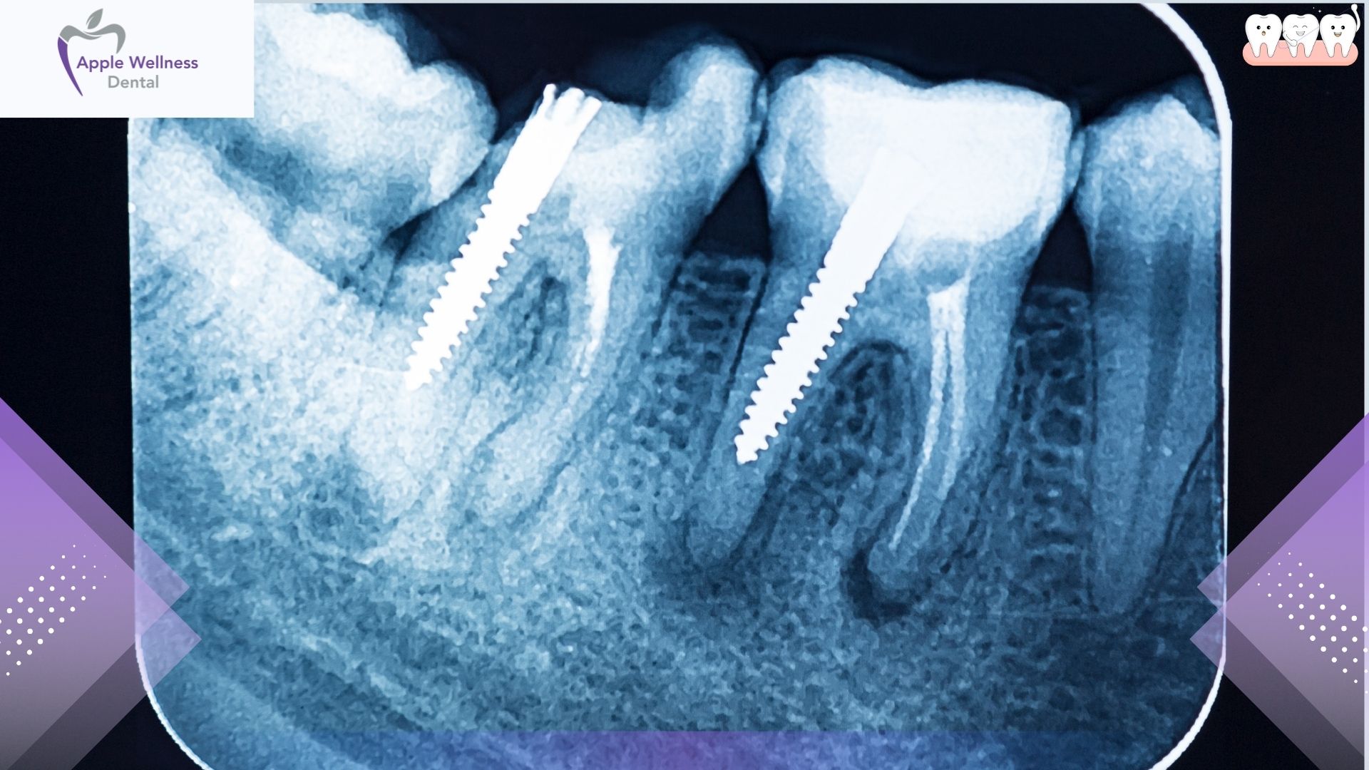 How Do Dentists Treat Knocked Out Teeth in Airdrie Today - Apple Wellness Dental