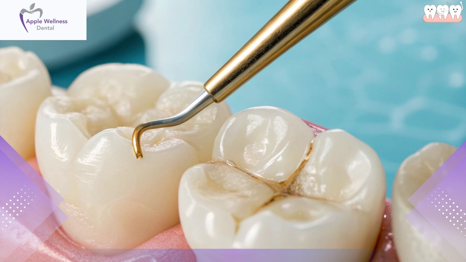 What Should You Do If You Lose a Filling - Apple Wellness Dental What Should You Do If You Lose a Filling - Apple Wellness Dental