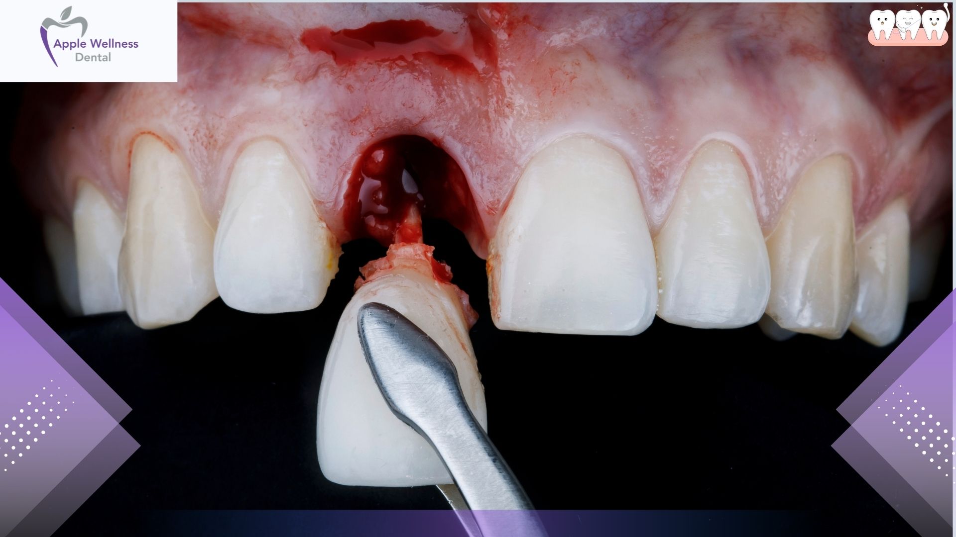 When Is a Dental Extraction Necessary for Oral Health - Apple Wellness Dental