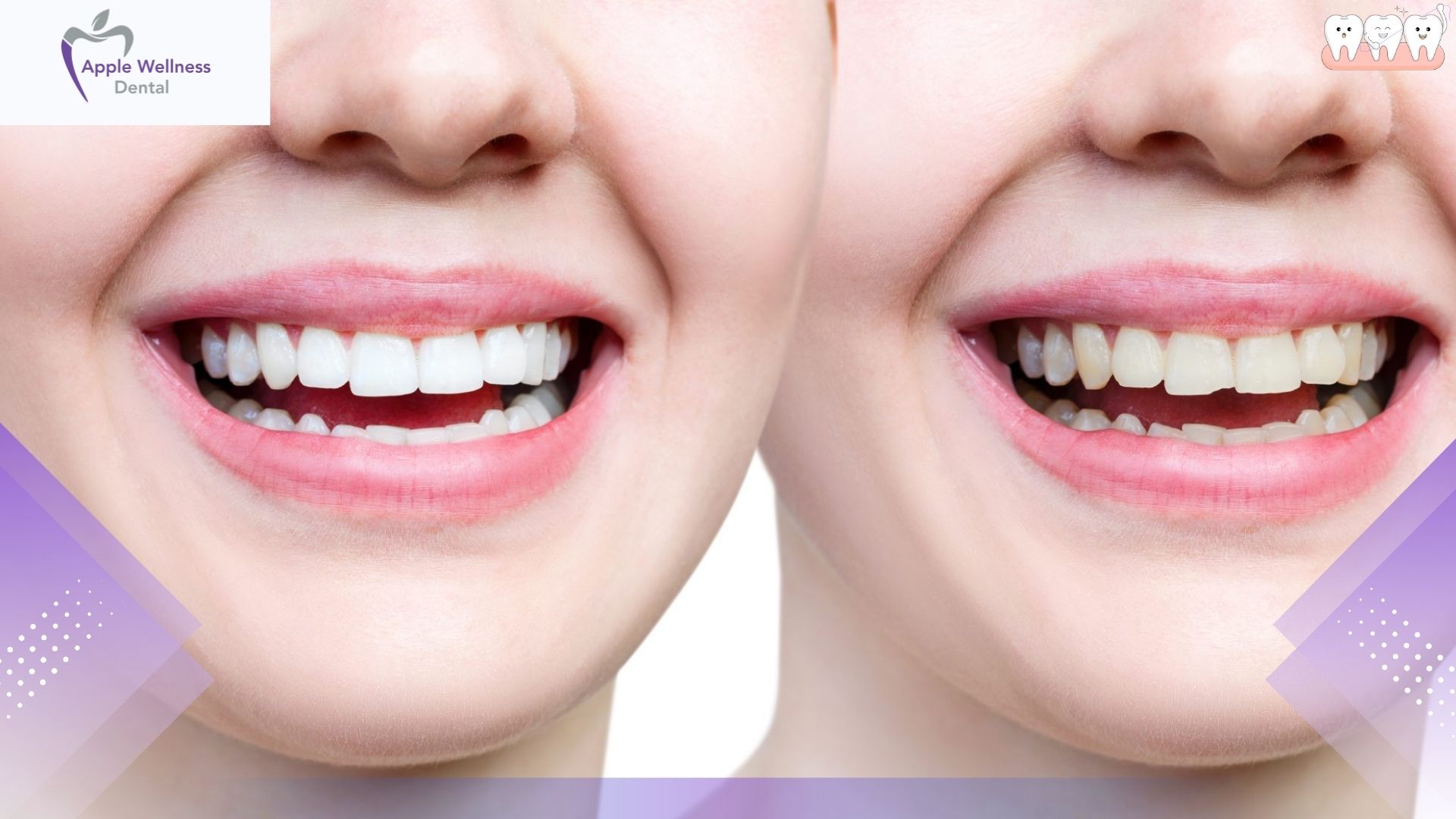 When Should You Visit a Dentist for a Chipped Tooth in Airdrie - Apple Wellness Dental
