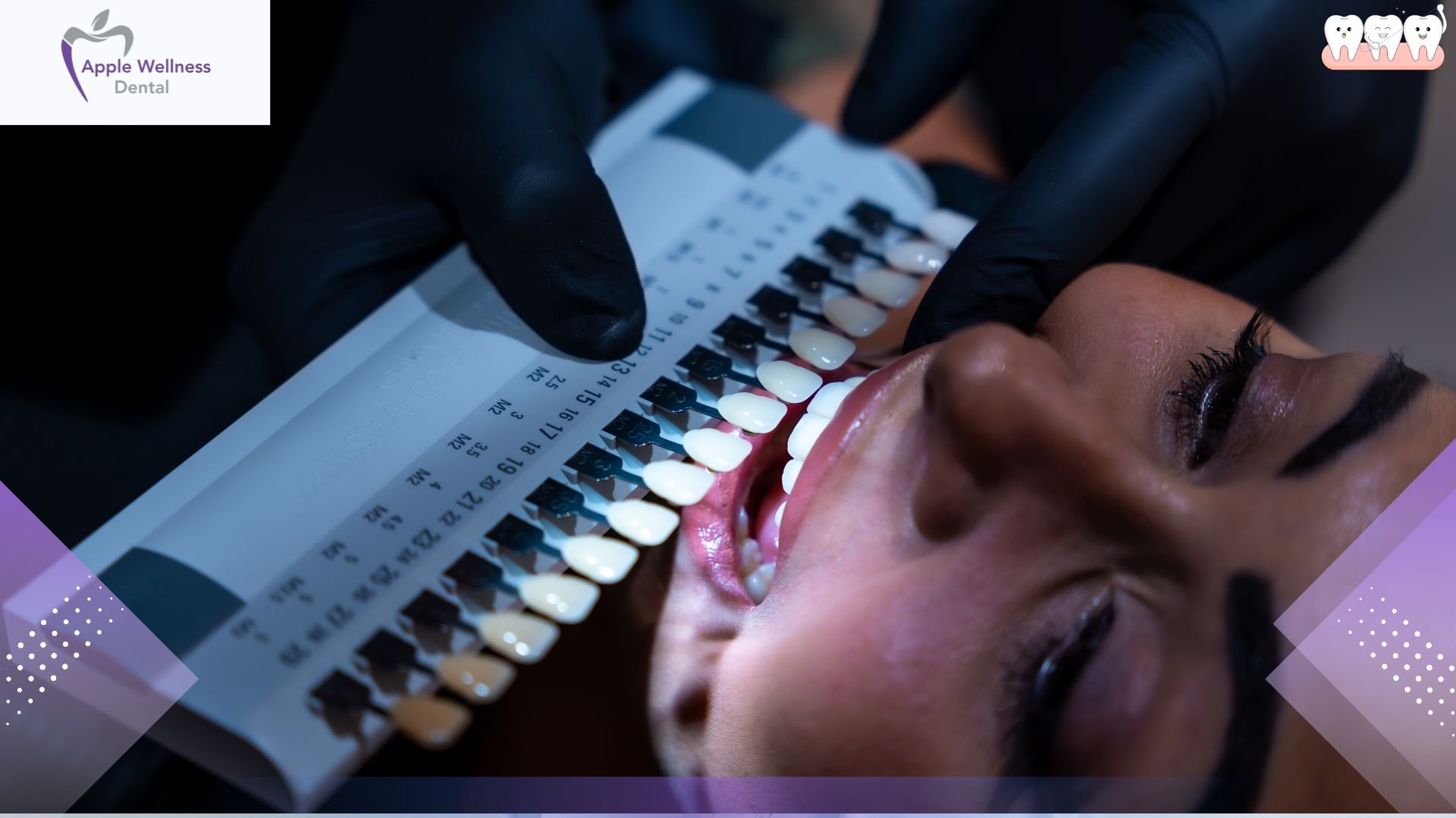 What is Teeth Whitening | Professional Dental Guide - Apple Wellness Dental