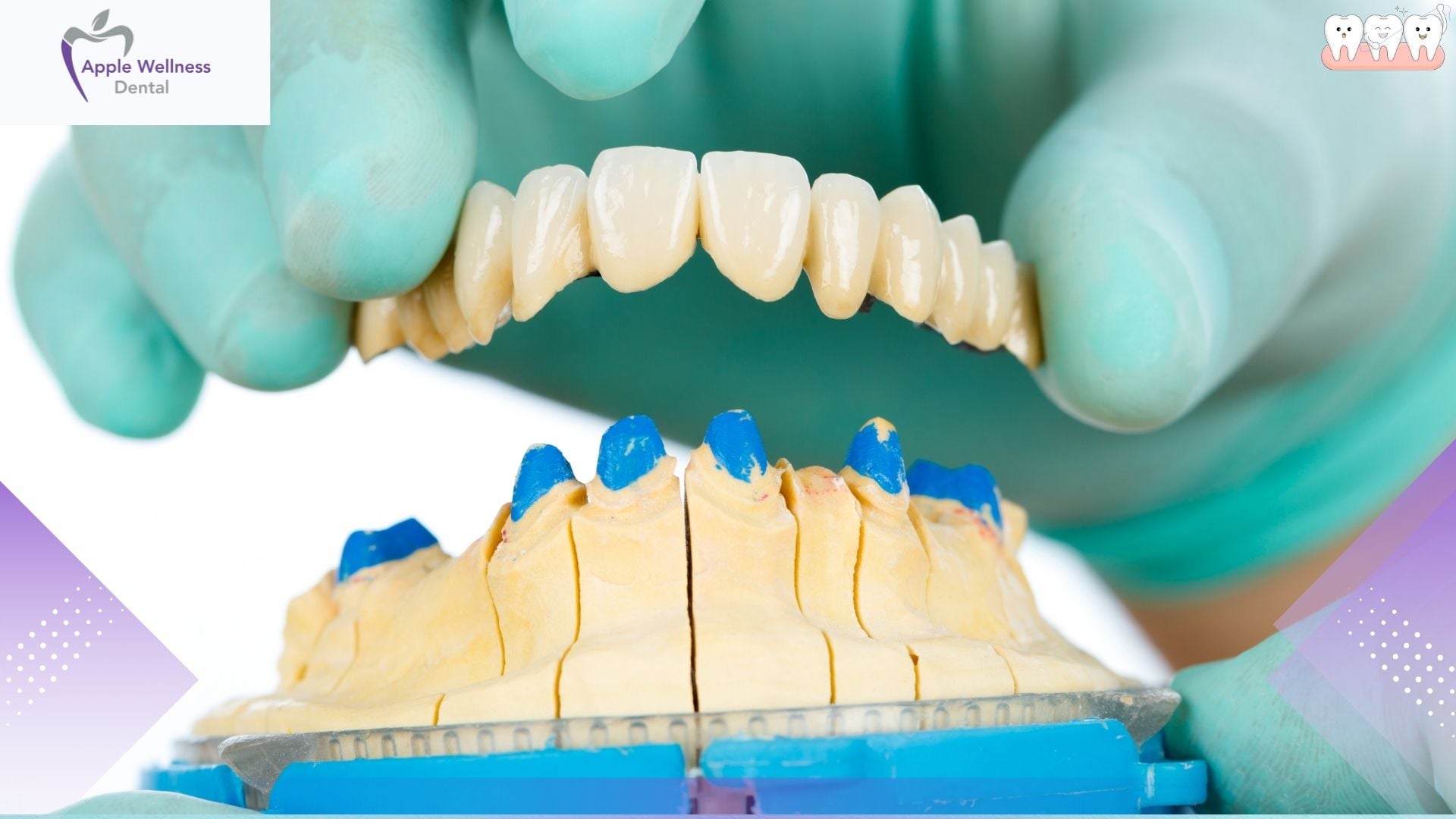 When Are Crowns and Bridges Recommended in Airdrie? Local Guide - Apple Wellness Dental